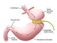 Home. gastric2